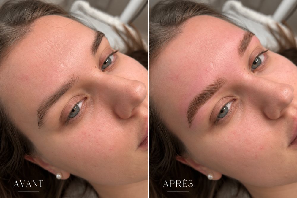 Avant et après un browlift russe réalisé par Raby