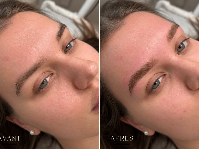 Avant et après un browlift russe réalisé par Raby
